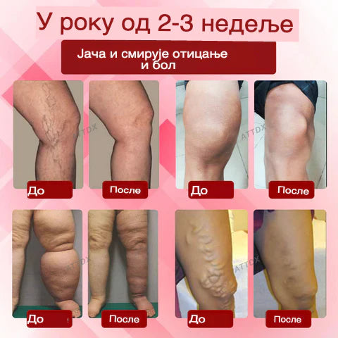 EdemaCare krema